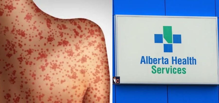 Read more about the article Surge in Measles: AHS Issues Public Exposure Alerts in Edmonton